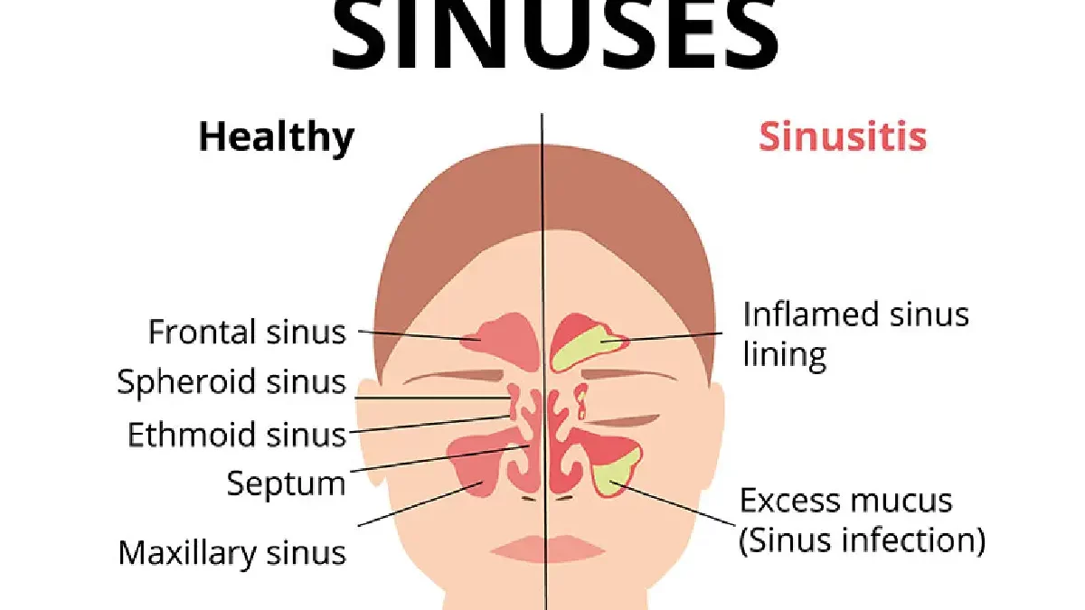 What Causes Nasal Congestion And How Is It Treated?