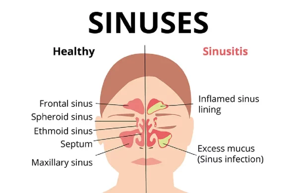 What Causes Nasal Congestion And How Is It Treated_