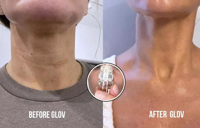 Glov Beauty Micro Infusion before and after 4 weeks results
